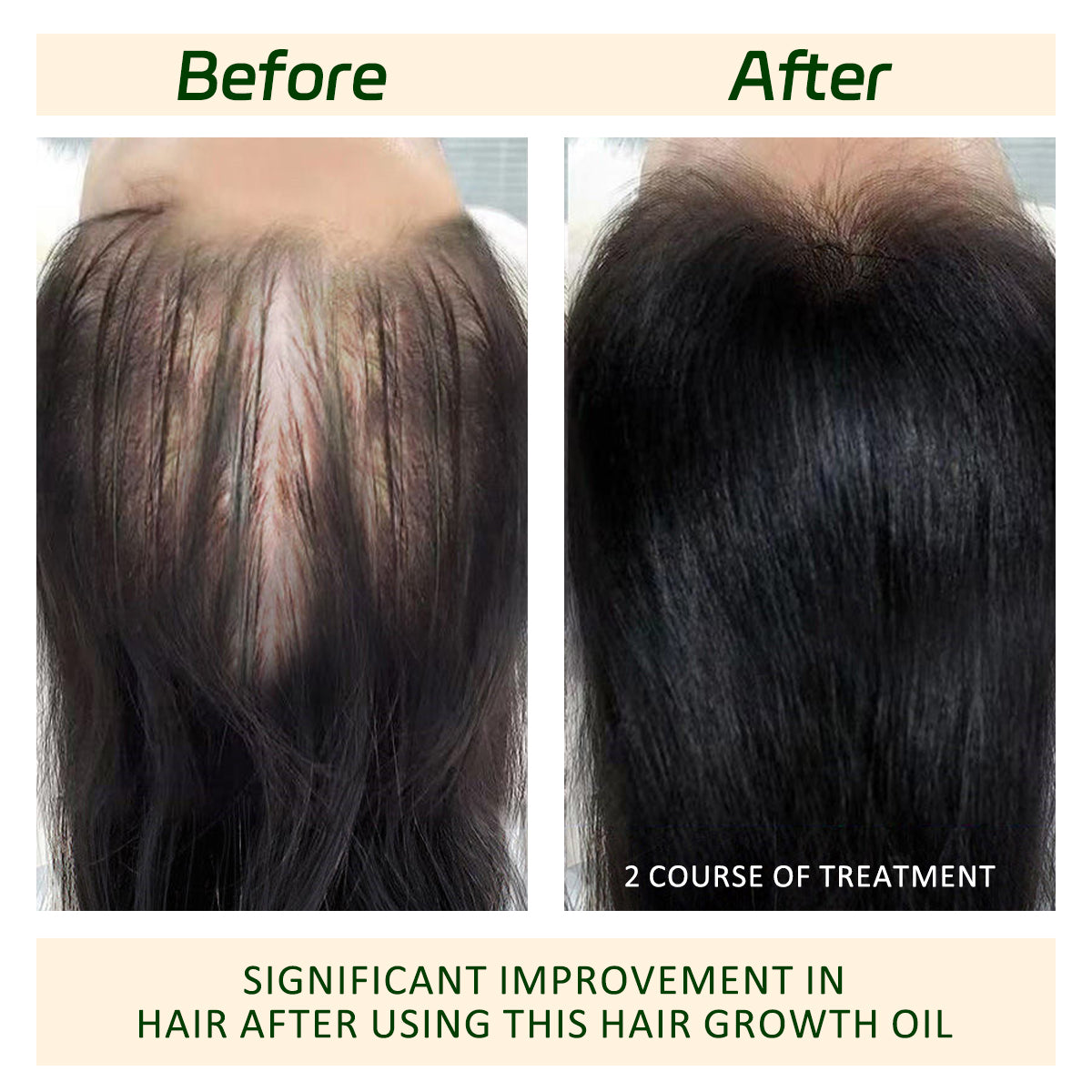 Batana oil and Rosemary oil, for promoting Hair Growth, Nourishing the scalp, Strengthening healthy hair,Organic Batana Oil reducing hair loss, and detoxifying the scalp(30 mL).Suitable for both women and men,Haircare Daily